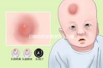 白癜風(fēng)的發(fā)病原因(白癜風(fēng)有自愈的嗎)