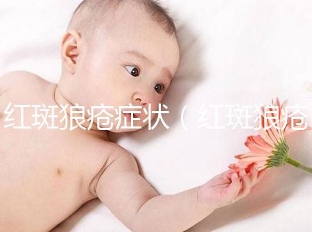 紅斑狼瘡癥狀（紅斑狼瘡癥狀表現(xiàn)有哪些）