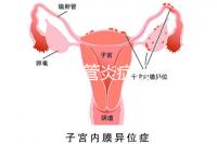 反流性食管炎癥狀(反流性食管炎癥狀有哪些反應)