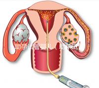助孕試管嬰兒(助孕試管嬰兒保險)