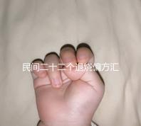 民間二十二個(gè)退燒偏方匯總,生雞蛋清、生姜放腳底還有…