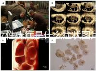 女性疣病是什么癥狀圖片(女生下面長(zhǎng)了疙瘩圖片)