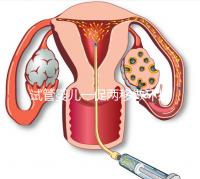試管嬰兒一促兩移做環(huán)扎好看嗎?小心這些影響