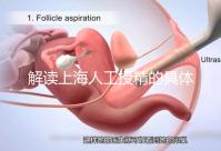 解讀上海人工授精的具體過程，會不會痛看醫生怎么說？