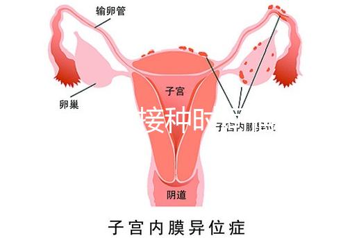 麻疹疫苗接種時間指南，初種年齡最好不要晚于這個月齡