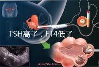 TSH高了，FT4低了，需要補碘嗎？