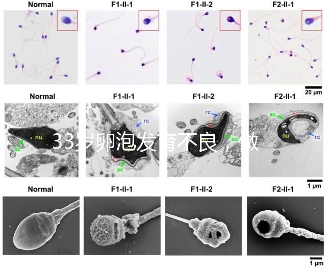 33歲卵泡發育不良，做試管黃體期促排方案失敗怎么辦？